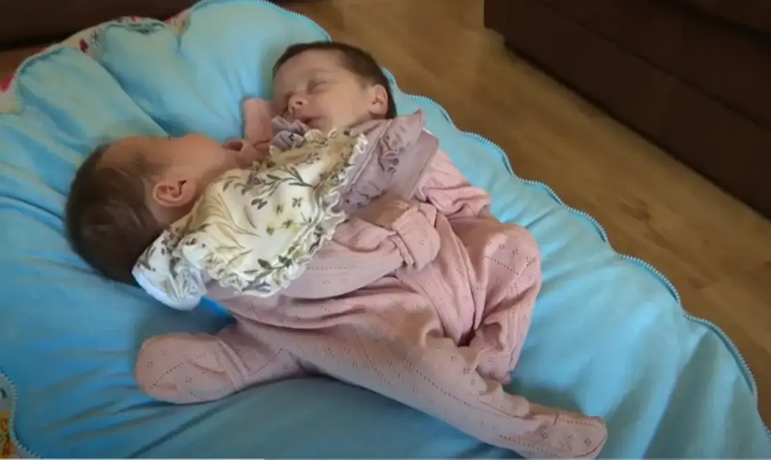 רגל אחת משותפת ולבבות נפרדים: תאומות סיאמיות נולדו אחרי היריון מדאיג