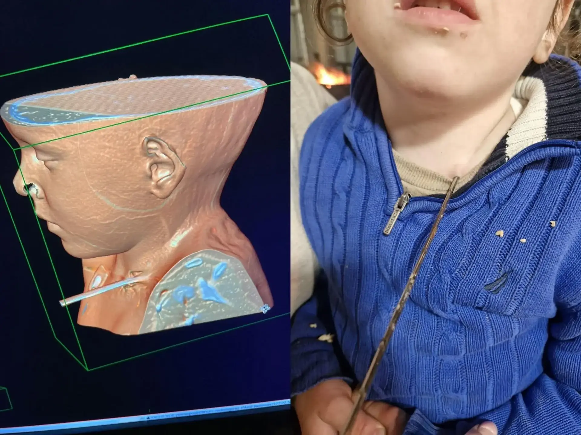 הרופאים בשניידר לא האמינו: בן 5 הובא עם שיפוד תקוע בחזה