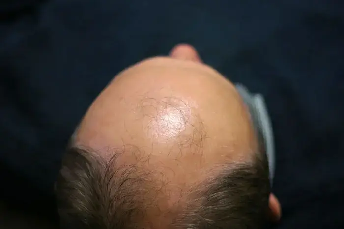 מעתה אל תאמר קרחת, אלא "שערות בלתי נראות"