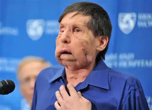 מושתל הפנים השני "מקווה להתחלה חדשה"