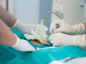 דיקור מי שפיר לאישה בהריון