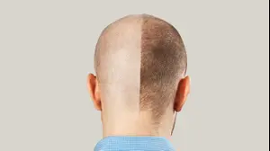 השתלת שיער (ShutterStock)