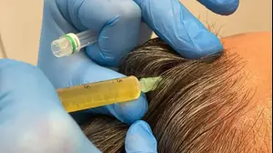 איילת גייר - השתלת שיער ( , יח"צ)