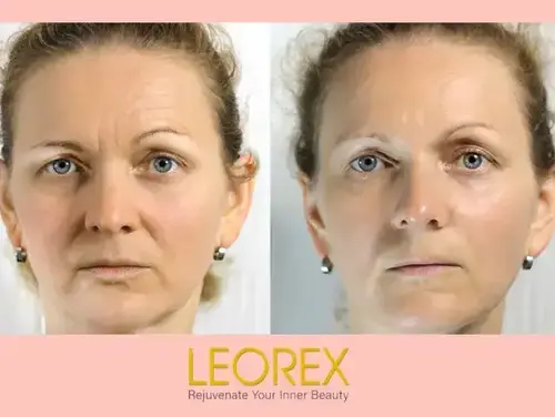 LEOREX - красивая кожа в любом возрасте LEOREX - красивая кожа в любом возрасте