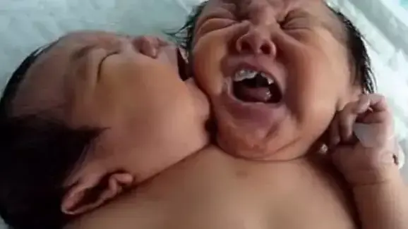 תאומות סיאמיות שנולדו כשהן חולקות את אותו הגוף ורק ראשיהן נפרדים, סצ'ואן, סין תאומות סיאמיות שנולדו כשהן חולקות את אותו הגוף ורק ראשיהן נפרדים, סצ'ואן, סין