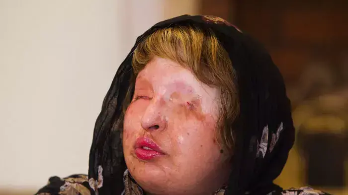 אמנה בהרמי, אשה אירנית שהתעוורה כשחברה שפך חומצה על פניה אמנה בהרמי, אשה אירנית שהתעוורה כשחברה שפך חומצה על פניה