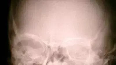 צילום רנטגן של סכין בתוך גולגולת צילום רנטגן של סכין בתוך גולגולת