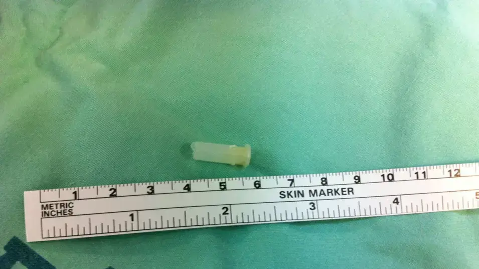 ילדה בת שש מאזור הצפון בלעה צפצפה בשוגג, פברואר 2013 ילדה בת שש מאזור הצפון בלעה צפצפה בשוגג, פברואר 2013