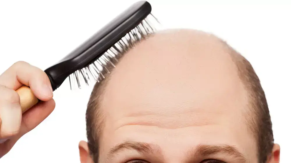 תקווה חדשה למיליוני מתקרחים ברחבי העולם?