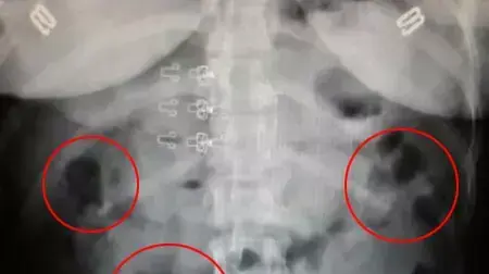 המשטרה הצליחה לסכל הברחת קוקאין שהוברח בקיבתם של גבר ואישה כבני 40, בתמונה: צילום הרנטגן בבית החולים, מרץ 2014 המשטרה הצליחה לסכל הברחת קוקאין שהוברח בקיבתם של גבר ואישה כבני 40, בתמונה: צילום הרנטגן בבית החולים, מרץ 2014