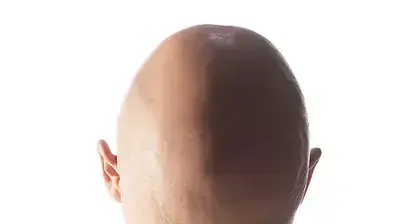 צילום אילוסטרציה קרחת צילום אילוסטרציה קרחת