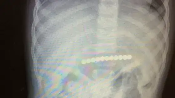 צילום הרנטגן של ילדה בת שנתיים שבגופה נמצאו מגנטים. יולי 2014 צילום הרנטגן של ילדה בת שנתיים שבגופה נמצאו מגנטים. יולי 2014