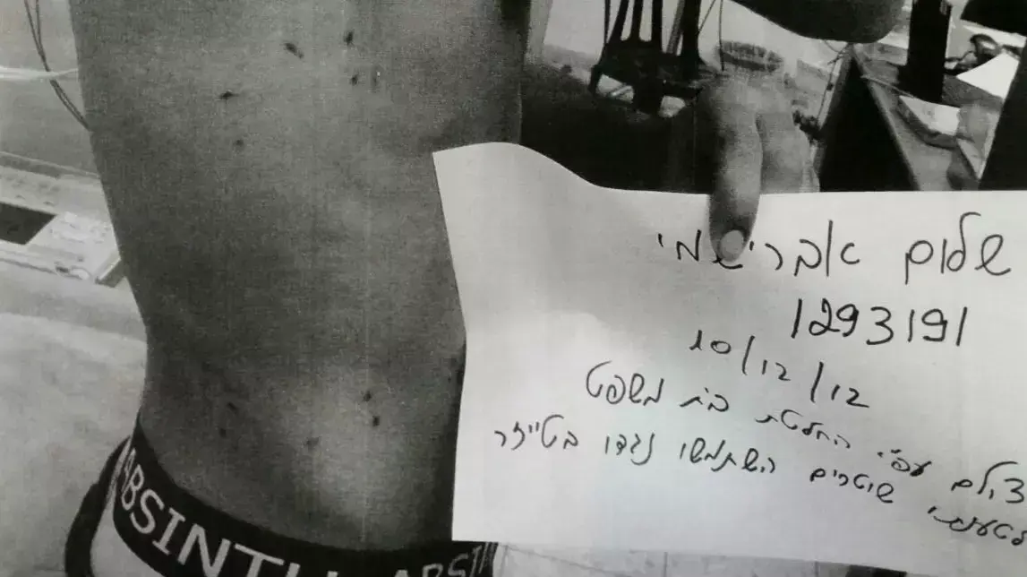 תוצאות שימוש באקדח טייזר כפי שנראה לכאורה על גופו של שלום אברישמי תוצאות שימוש באקדח טייזר כפי שנראה לכאורה על גופו של שלום אברישמי