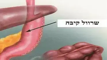 שרוול קיבה שיטת ניתוח חדשה לסובלים מהשמנת יתר שרוול קיבה שיטת ניתוח חדשה לסובלים מהשמנת יתר