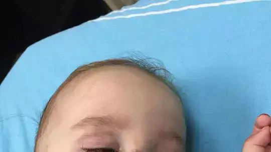 תינוק שננשך ידי חולדה תינוק שננשך ידי חולדה