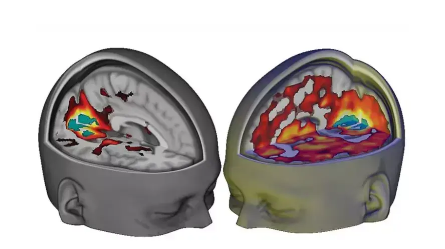 מימין המוח על LSD, משמאל על פלצבו מימין המוח על LSD, משמאל על פלצבו