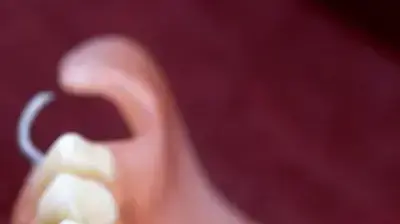 שיניים תותבות שיניים תותבות