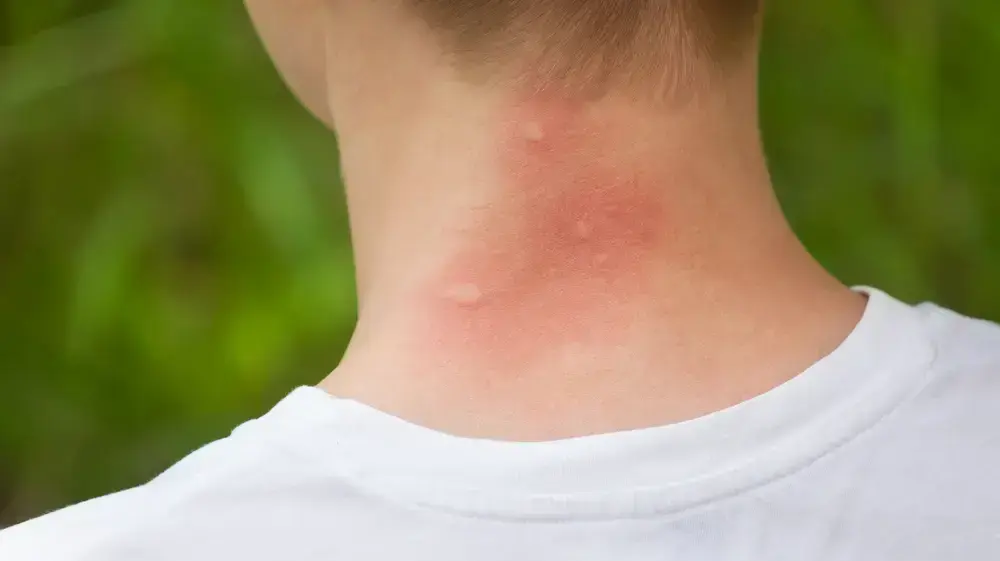 עקיצות יתוש עקיצות יתוש