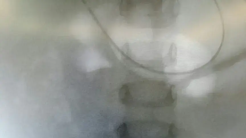 בן שנתיים בלע שרשרת מגנטים שהוצאה בניתוח בשניידר, צילום: דוברות שניידר בן שנתיים בלע שרשרת מגנטים שהוצאה בניתוח בשניידר, צילום: דוברות שניידר