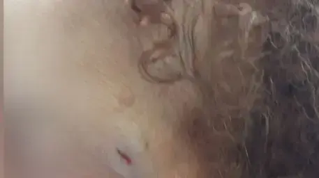 קשישה שהותקפה בהרצליה, יולי 2017 קשישה שהותקפה בהרצליה, יולי 2017