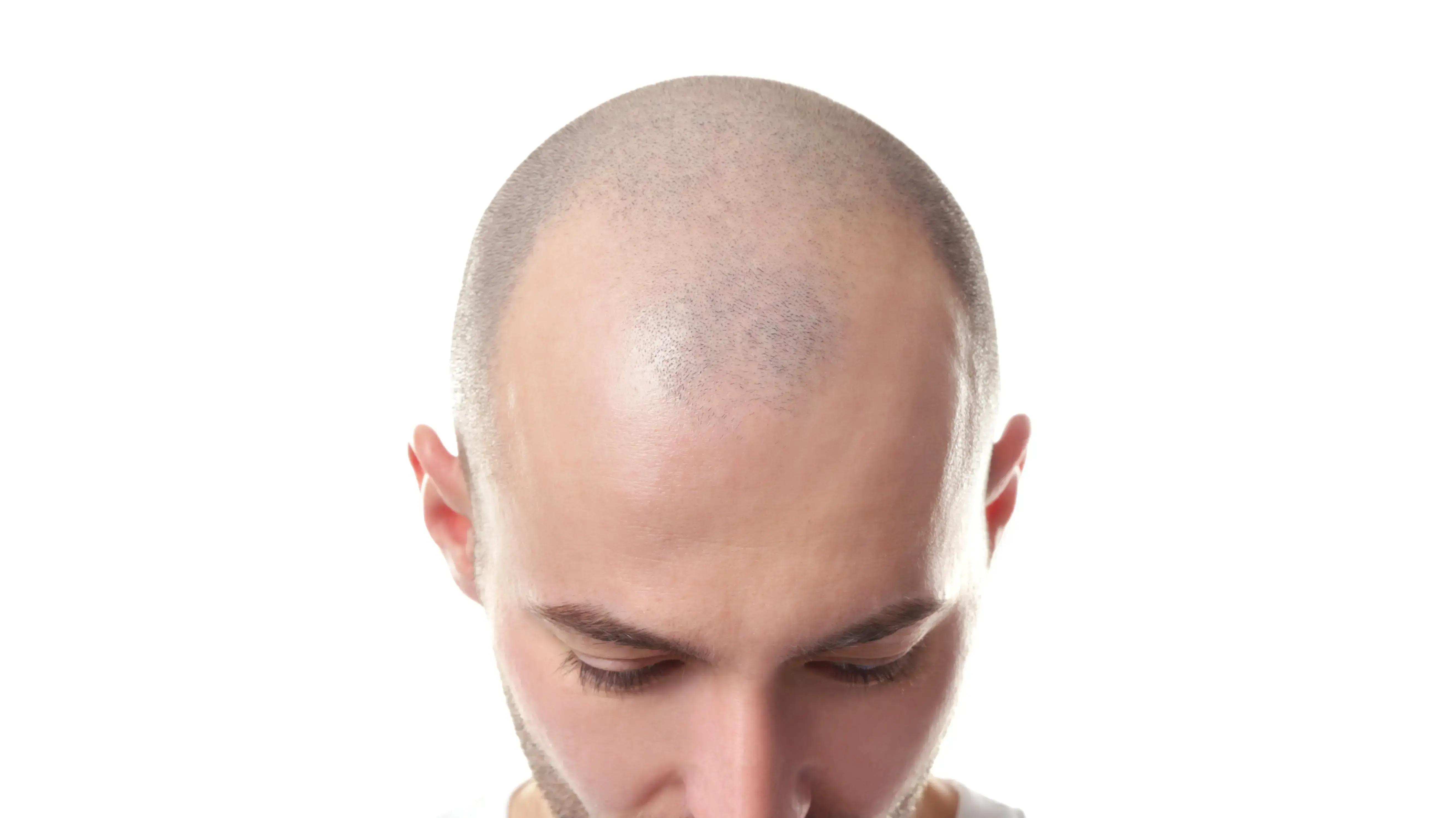 התקרחות דמדיקו התקרחות דמדיקו