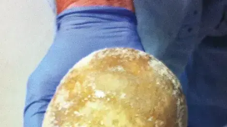 האבן שהוסרה בניתוח, לאחר הוצאתה מגופו של החולה. כמעט בגודל של ביצת יען האבן שהוסרה בניתוח, לאחר הוצאתה מגופו של החולה. כמעט בגודל של ביצת יען