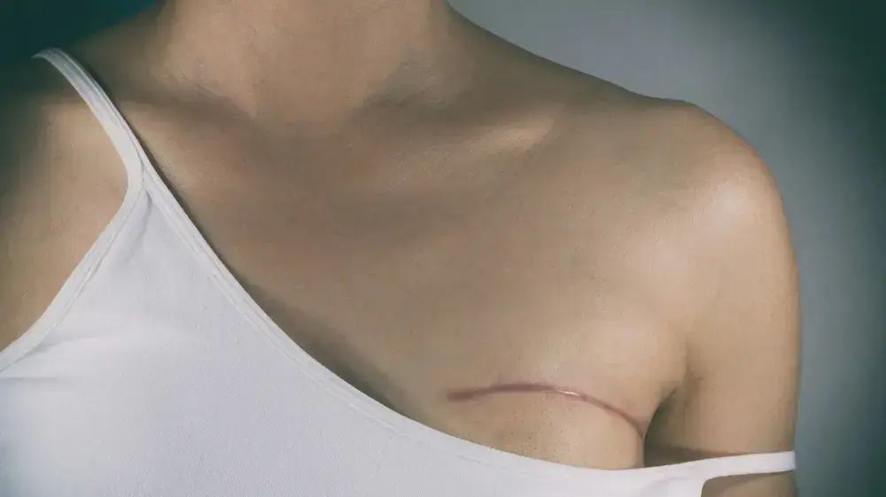 כולן צריכות להיבדק. אישה עם צלקת מניתוח שד כולן צריכות להיבדק. אישה עם צלקת מניתוח שד