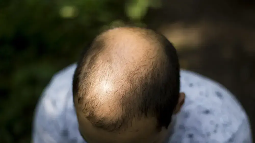 השיער האנושי עובר שלושה מחזורי צמיחה: אנאגן, קטגן, הטלוגן. שיער מקריח השיער האנושי עובר שלושה מחזורי צמיחה: אנאגן, קטגן, הטלוגן. שיער מקריח