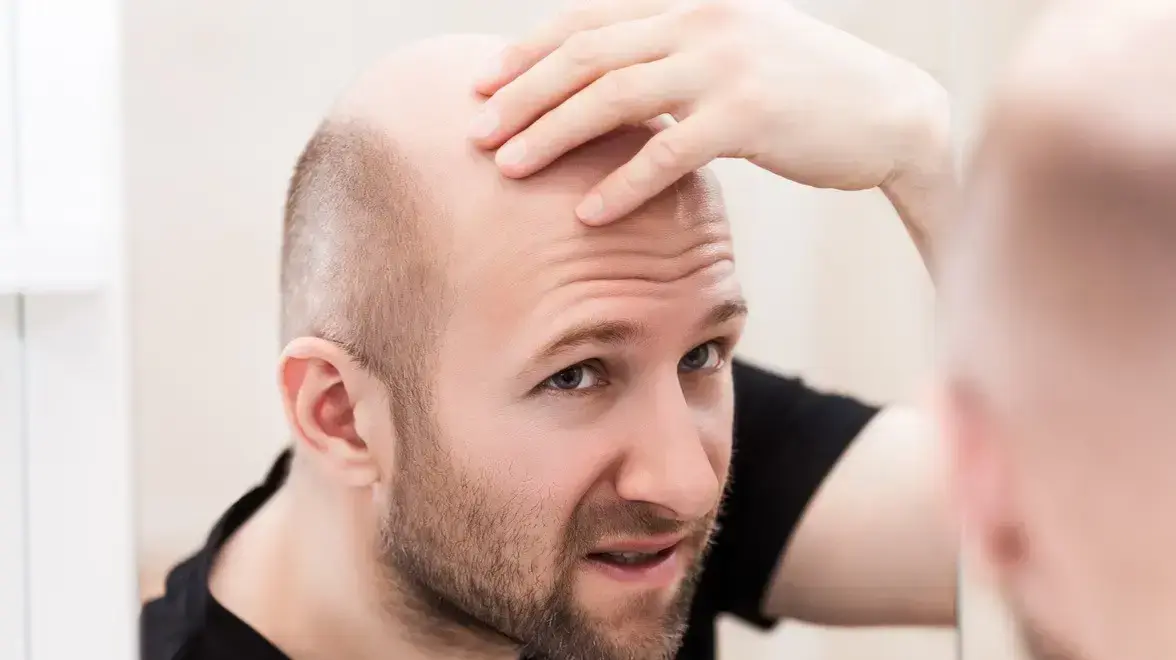 התקרחות התקרחות