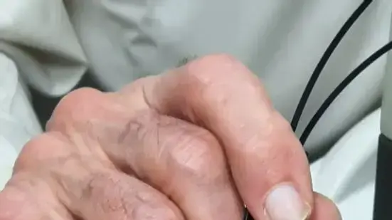 לכל נגע בעור יש "צבע" אחר. אבחון מלנומה במעבדה של פרופ' קציר לכל נגע בעור יש "צבע" אחר. אבחון מלנומה במעבדה של פרופ' קציר