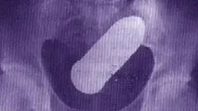 צילום רנטגן של רקטה שנתקעה בישבן של גבר צילום רנטגן של רקטה שנתקעה בישבן של גבר