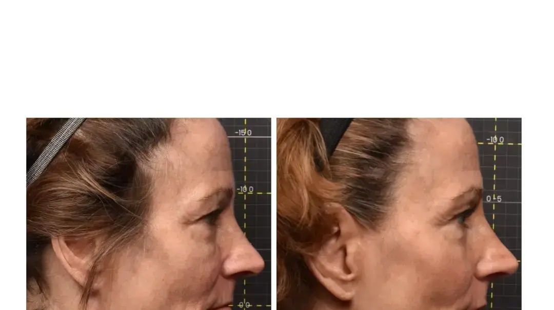 טיפול אחד, שינוי שמגיע אחרי כמה שבועות. אישה לפני ואחרי הטיפול החדש טיפול אחד, שינוי שמגיע אחרי כמה שבועות. אישה לפני ואחרי הטיפול החדש