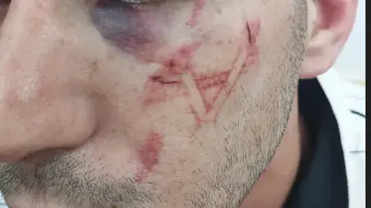 העצור הפלסטיני עם סימן של מגן דוד מתחת לעין
19.8.23 העצור הפלסטיני עם סימן של מגן דוד מתחת לעין
19.8.23