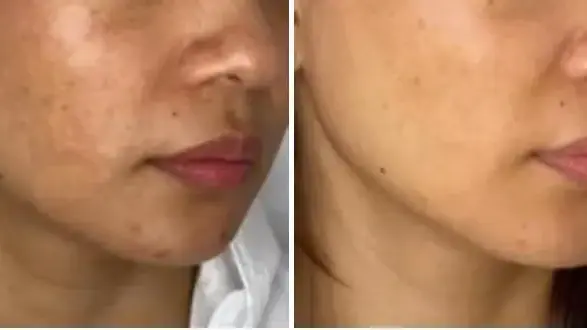 לפני ואחרי שימוש ב-CELLBOOSTER לפני ואחרי שימוש ב-CELLBOOSTER
