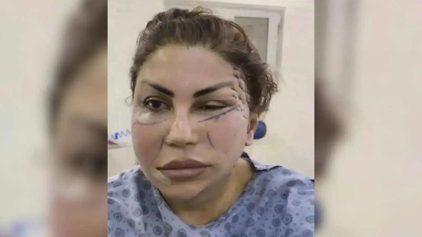 אישה שעברה ניתוחים קוסמטיים פיראטיים בעיראק אישה שעברה ניתוחים קוסמטיים פיראטיים בעיראק