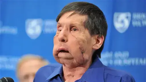 ג'יימס מקי מושתל הפנים השני ג'יימס מקי מושתל הפנים השני